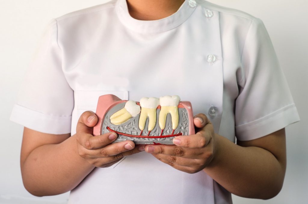 A dentist holds a model of wisdom teeth, which can also cause a migraine in addition to tooth pain.