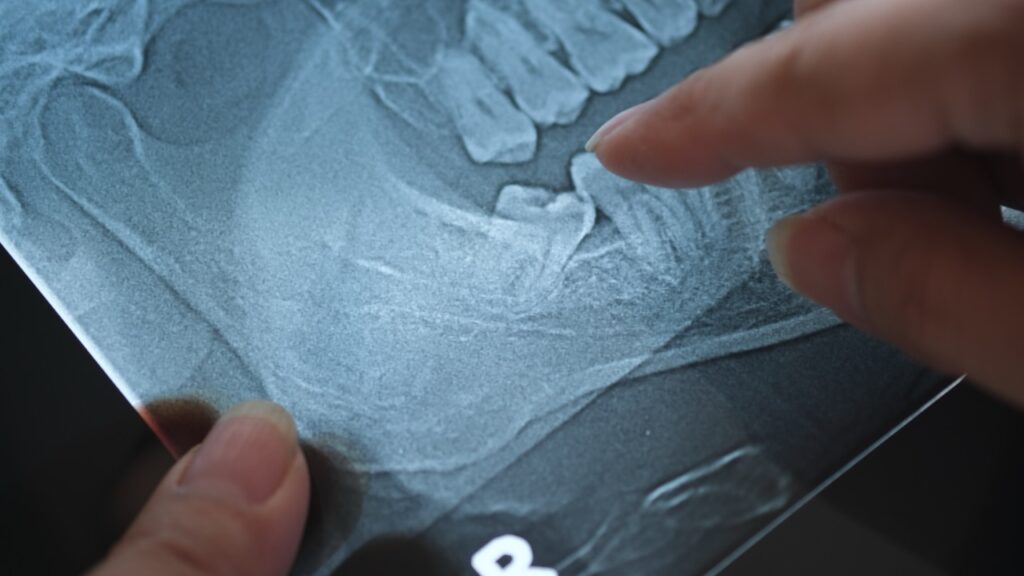 Oral surgeon examines X-ray image of impacted wisdom tooth, indicating need for wisdom teeth removal.