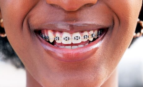 5 Braces Tips for Orthodontics Success