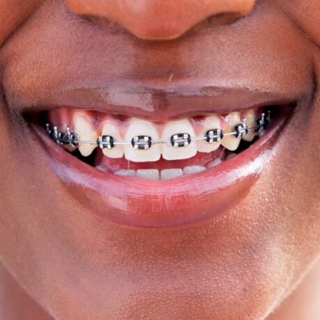 5 Braces Tips for Orthodontics Success