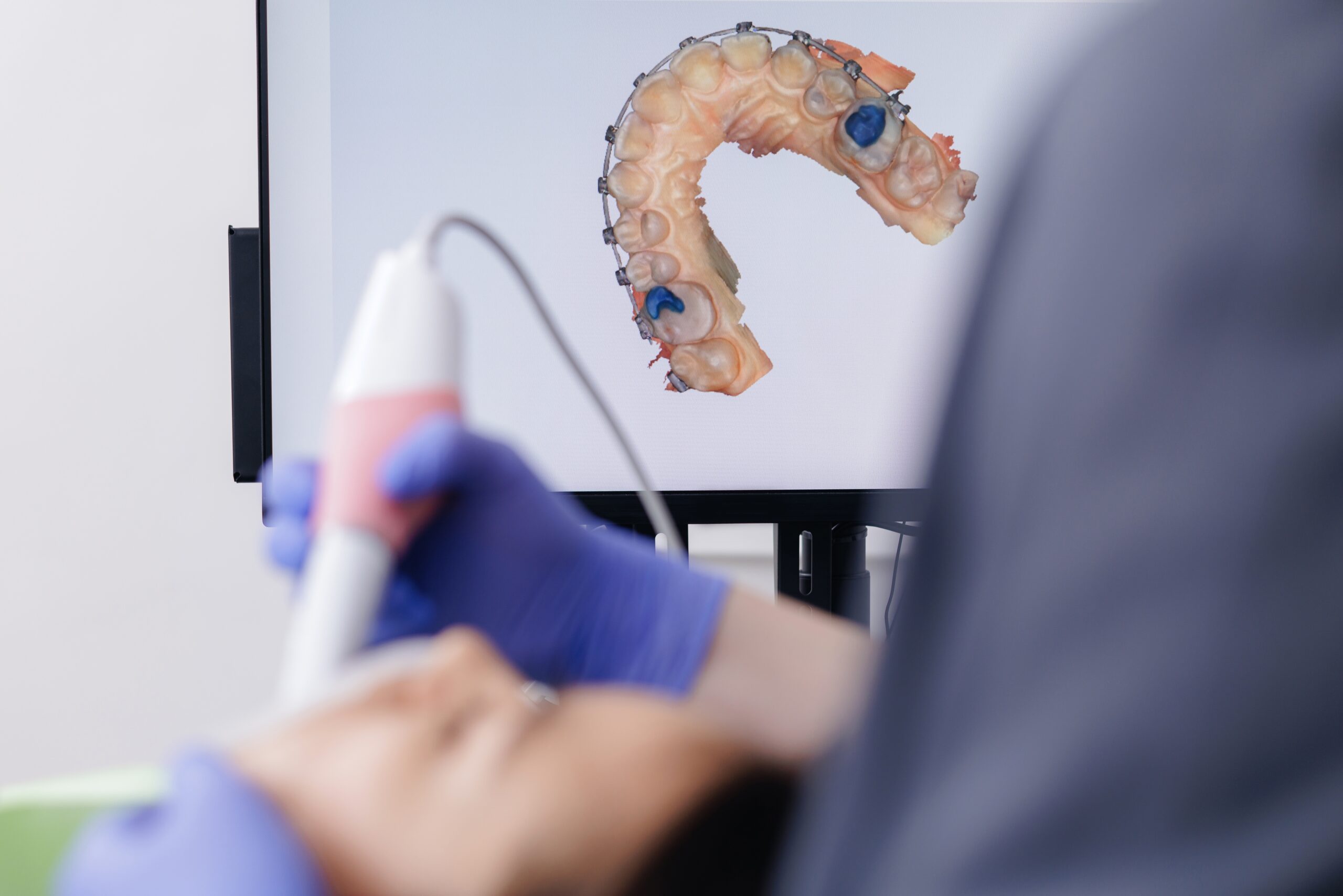 Dentist uses intraoral scanner to scan mouth of an orthodontic patient, creating dentistry digital imaging of his teeth.